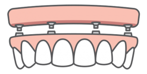 Illustration of an All-on-4 full-arch dental implant-supported bridge and how it fits onto four dental implants