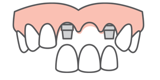 Three-tooth implant restoration ready to fill a gap by attaching it to two dental implant fixtures at each end of gap