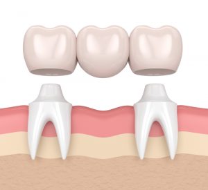 rendering of a dental bridge