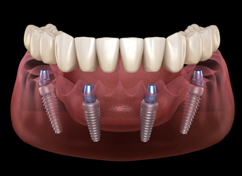 dental implants